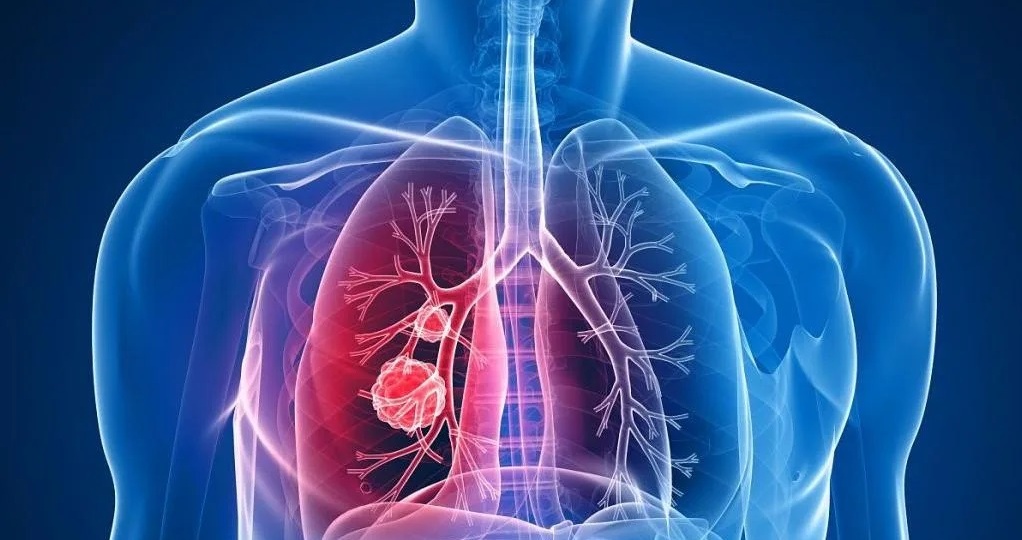 Кому следует опасаться РАКА ЛЁГКИХ