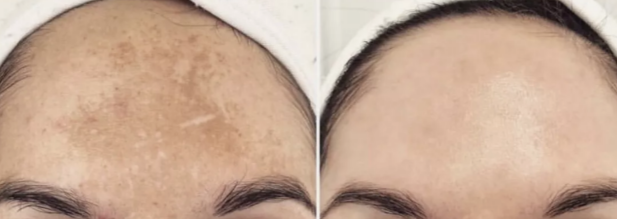 Cosmelan пилинг