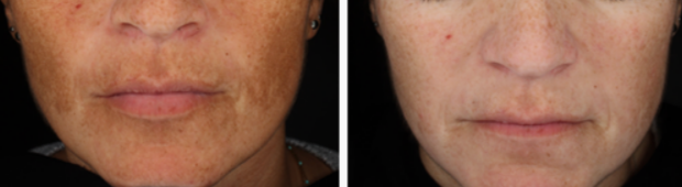 процедура Dermamelan до и после