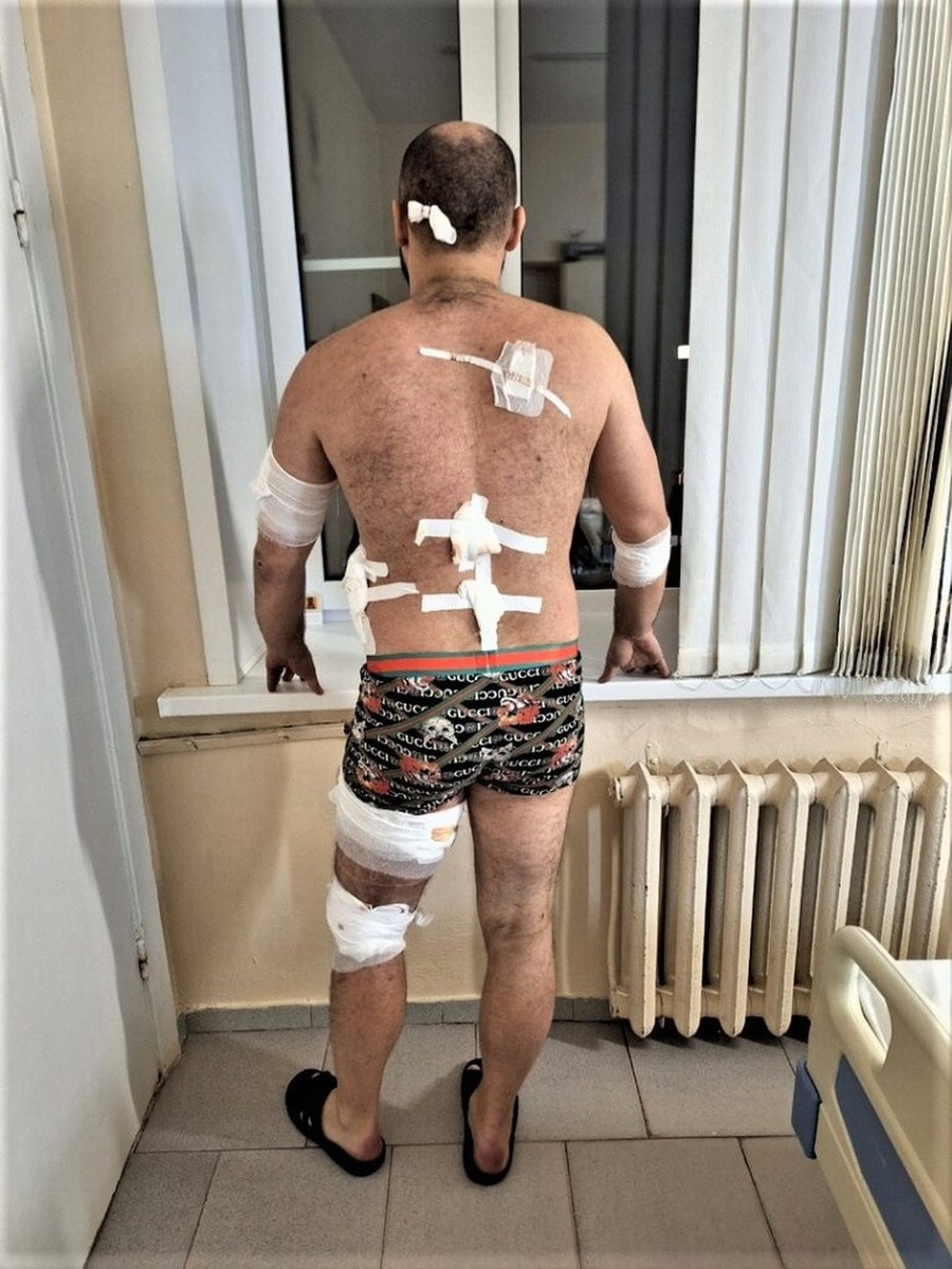    В Херсонской области Дееву посекло осколками практически все тело. из личного архива Вячеслава Деева.