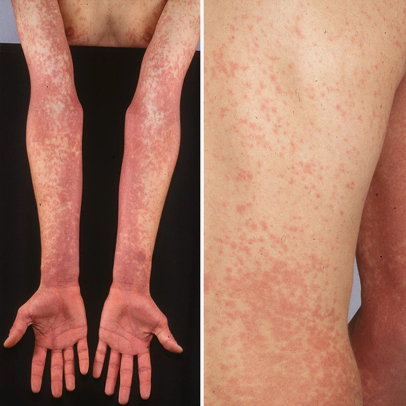 Так выглядит сыпь во время скарлатины. Дальневосточная скарлатиноподобная лихорадка может вызывать похожий симптом