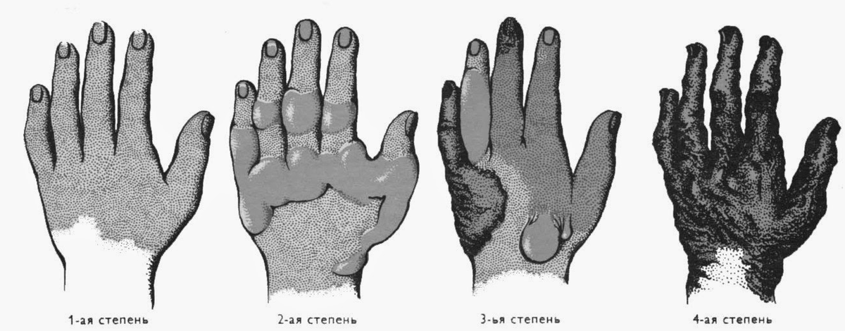 Степень ожога при поражение электрическим током