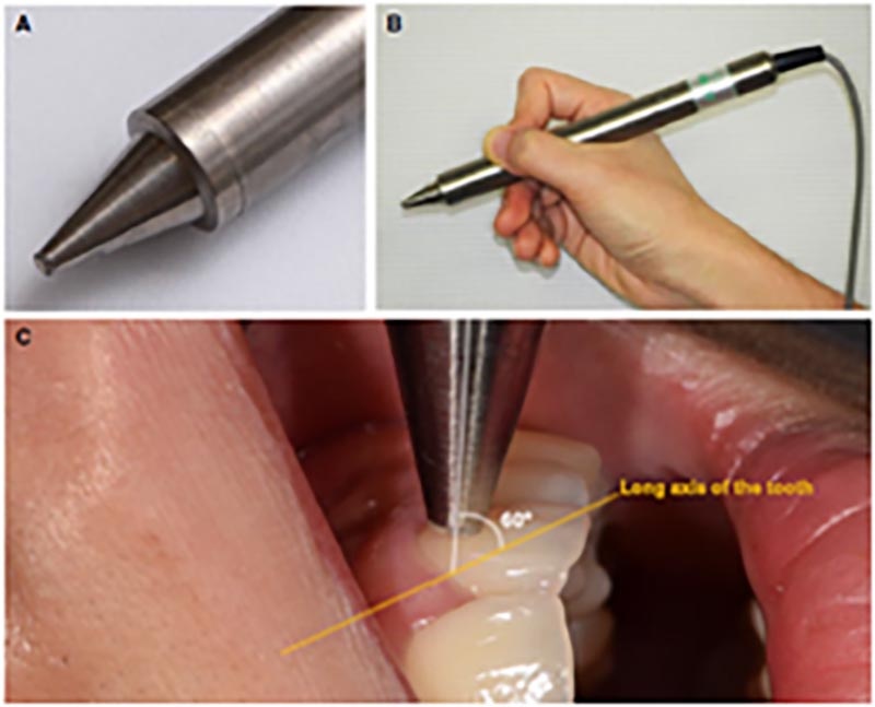 РИСУНОК 1. 20 МГц датчик устройства ультразвуковой допплерографии (ЗАО «Минимакс», Санкт-Петербург, Россия). (A) Наконечник датчика. (B) Датчик удерживается в руке. (C) Позиционирование датчика на центральном резце.