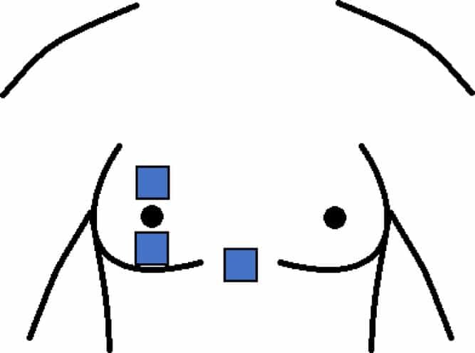    Плотность потовых желез и локальную потливость измеряли в зоне над и под сосками и в треугольнике бюстгальтера / © Experimental Physiology, Hannah Blount et al.