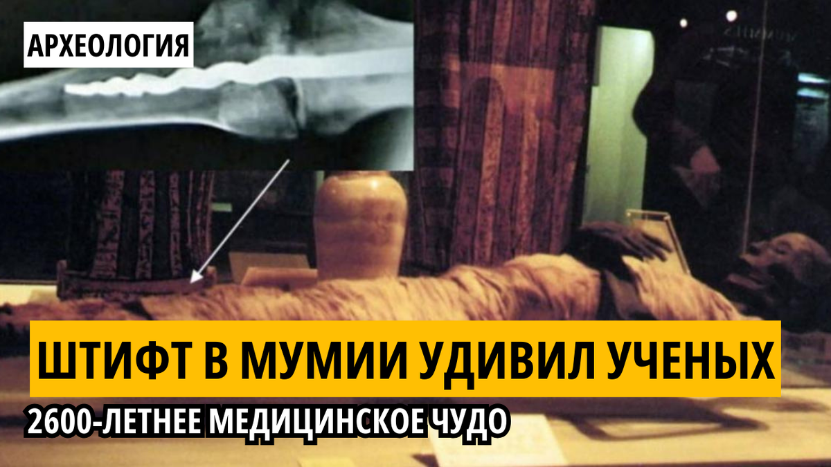 Мумифицированные останки Юзермонту, Розенкрейцерский музей Сан-Хосе. Врезка: Металлический штифт найденный в колене Юзермонту.