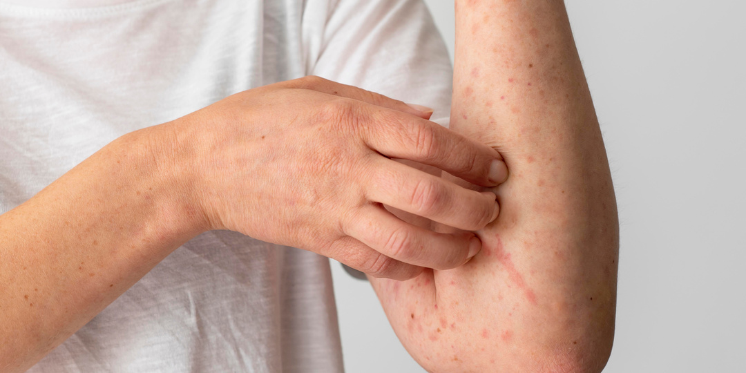 Краснеет, чешется и покрывается сыпью: как помочь коже при аллергических заболеваниях