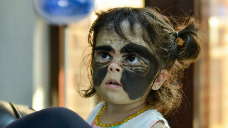Российские врачи помогают вернуть лицо пятилетней Луне Феннер. В соцсетях ее прозвали «девочкой в маске Бэтмена» из-за большого родимого пятна.