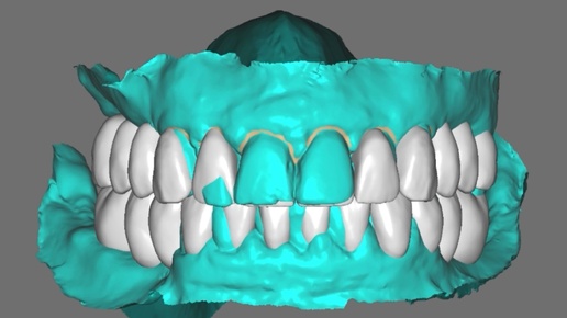 Виртуальная постановка (wax up) - то, с чего начинается цифровая имплантация