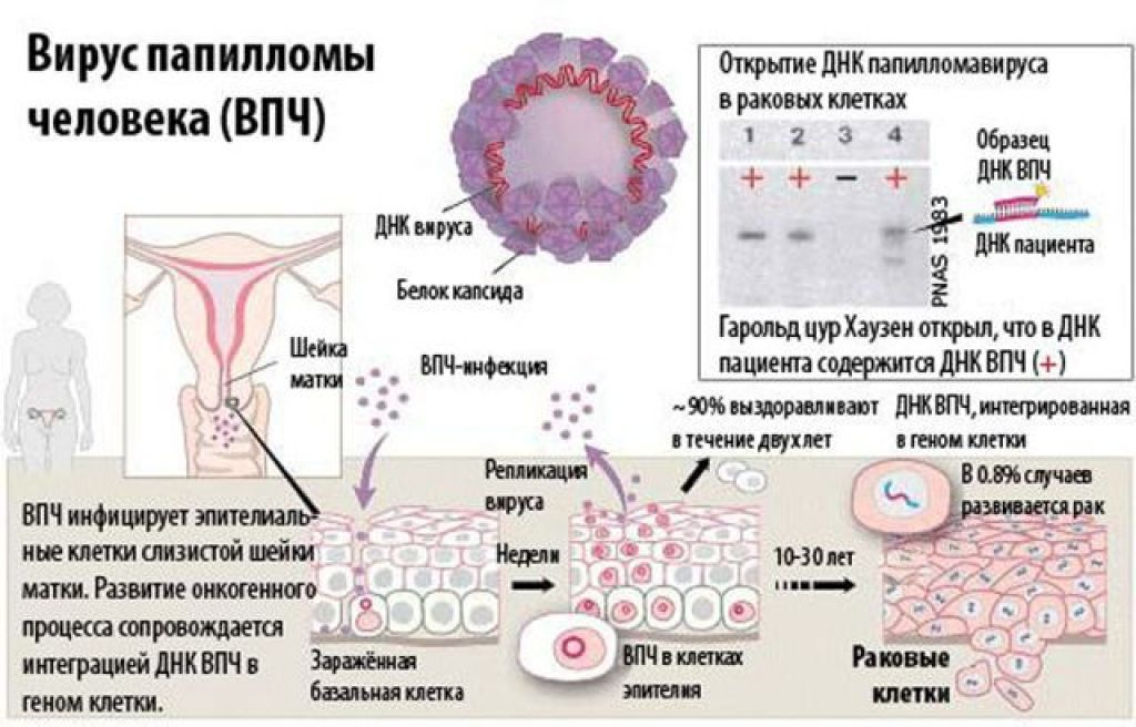 Впч тип 45 обнаружен