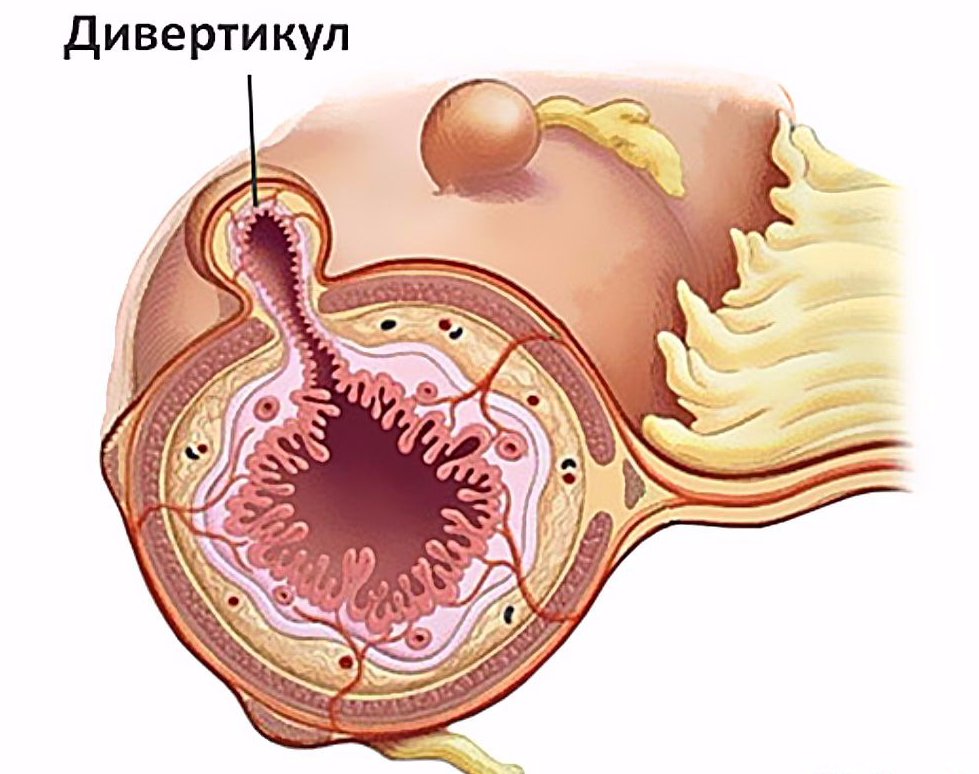 Сегодня расскажу, что такое дивертикулы.
⠀
Зачастую это случайная находка во время колоноскопии или КТ. Но когда пациенты открывают Гугл, их спокойная жизнь заканчивается.