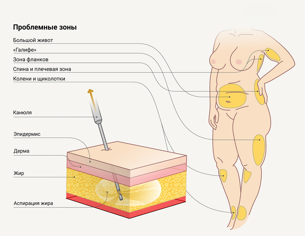 Частые проблемные зоны, с которыми можно побороться липосакцией