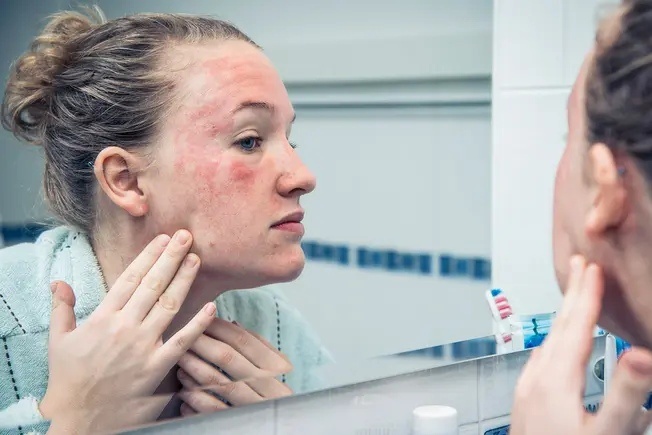 Экзема на лице