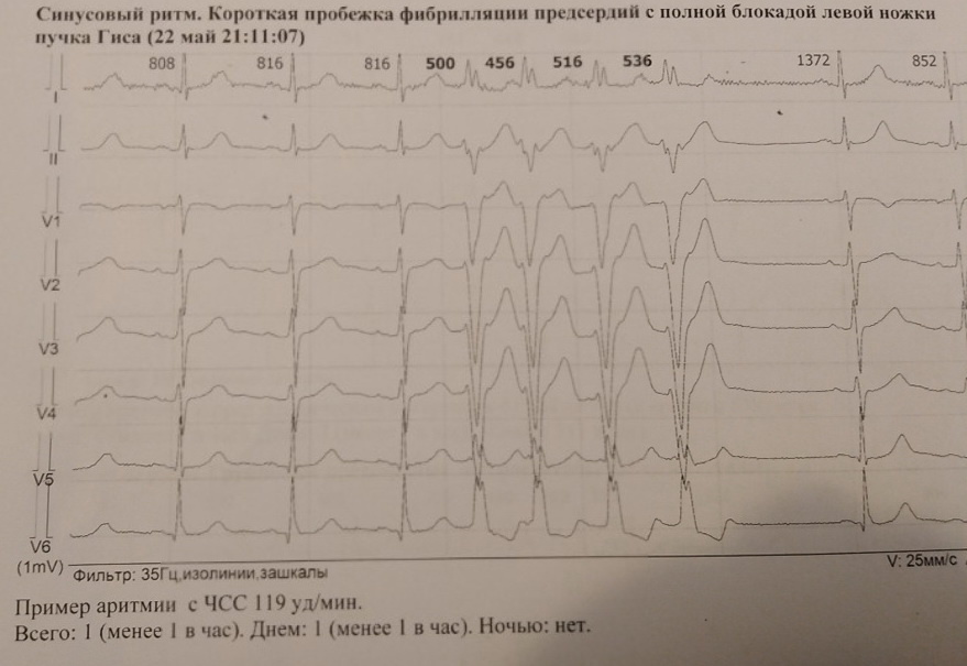 Приступ состоит всего из 4 комплексов. 