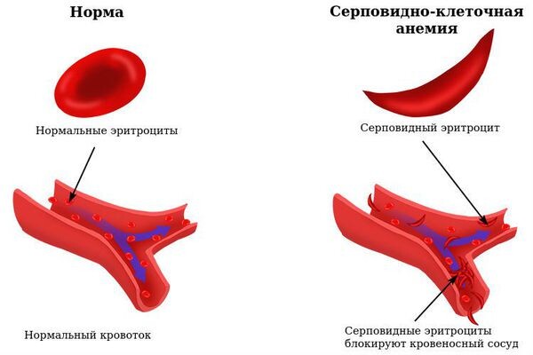 Ежегодно 19 июня отмечается Всемирный день осведомленности о серповидноклеточной анемии (наследственная генетическая аномалия строения гемоглобина).