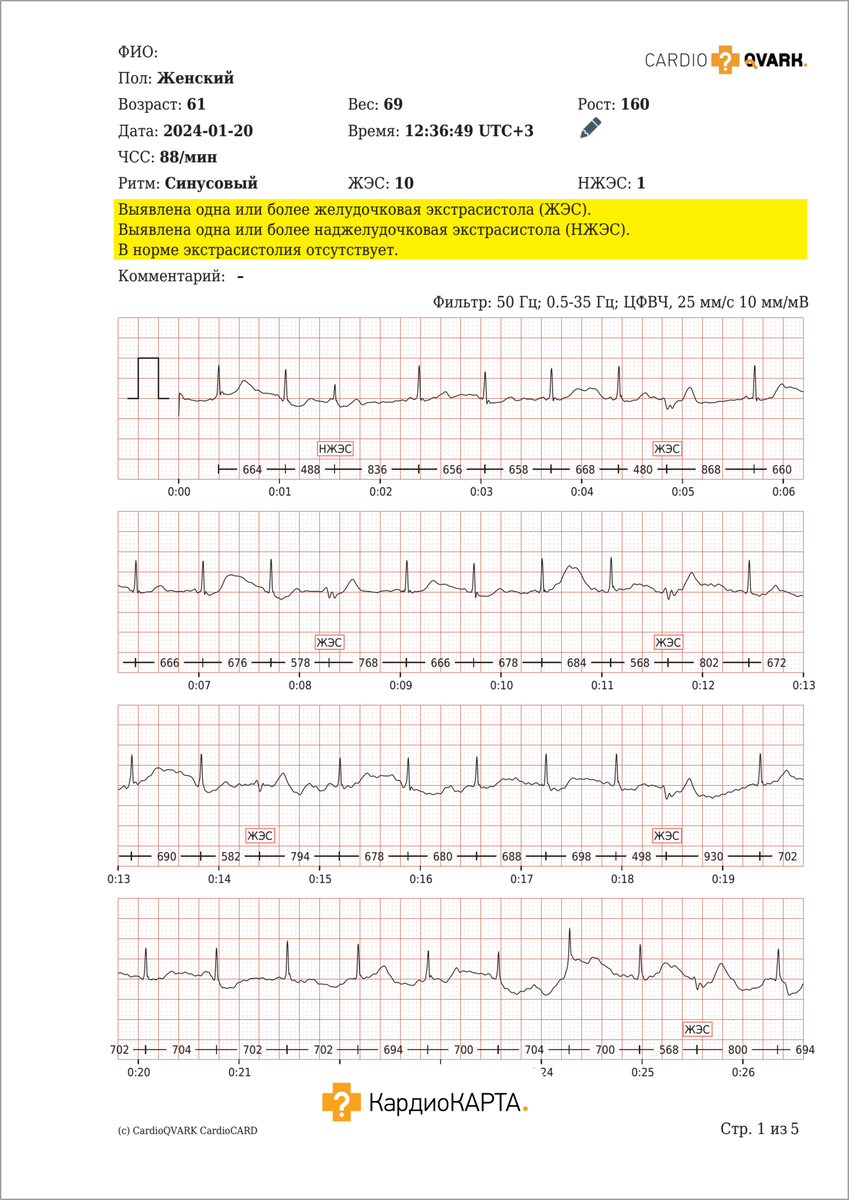 Неритмичное сердцебиение беспокоит вот уже 3 года. Случай из практики.  Экстрасистолическая аритмия. | КардиоКАРТА | Кардиология | Дзен