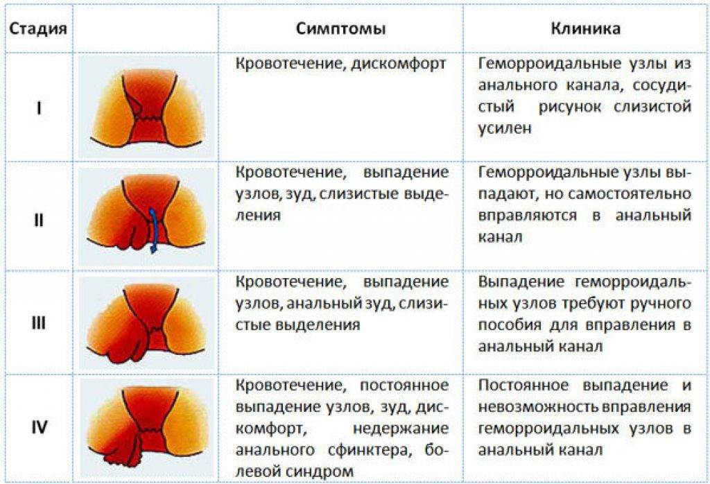 Лечение геморроя в казани