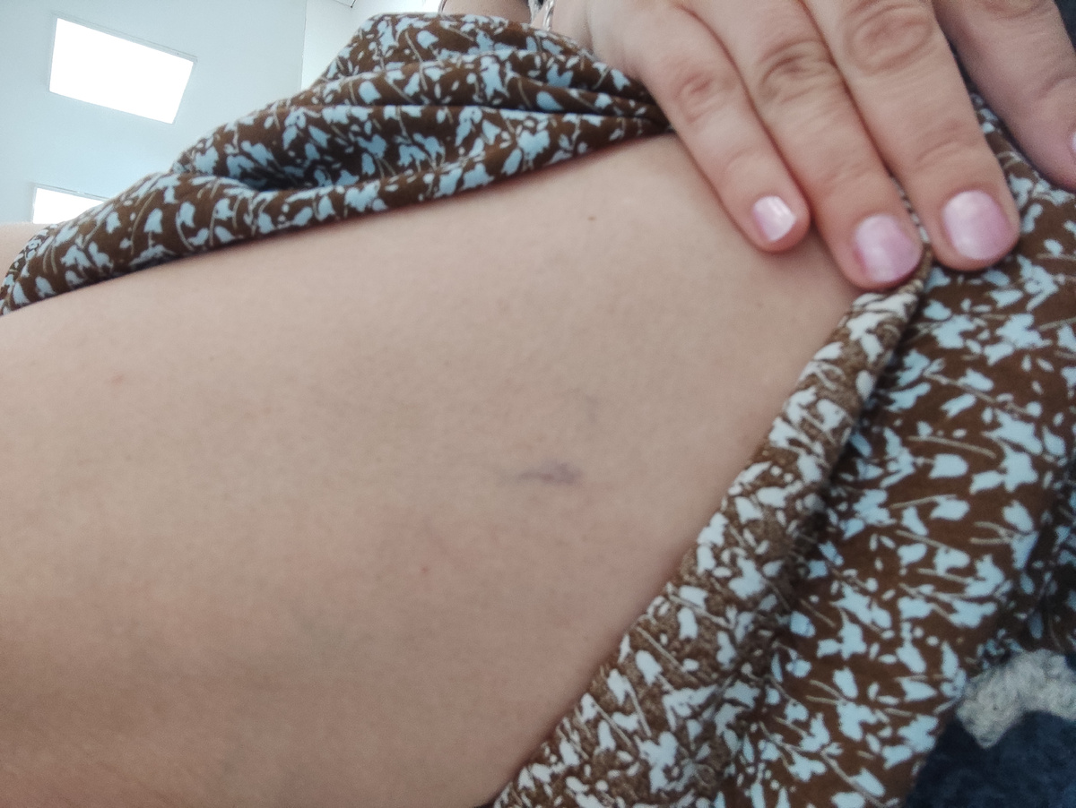 Закуток вены. 