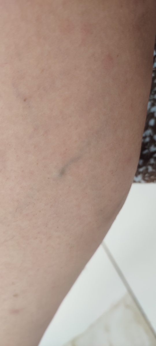 Расширенная вена. 