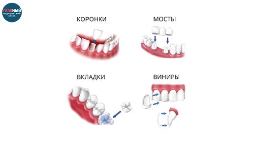 Протезирование зубов. Несъемные и съемные зубные протезы, накладки на зубы