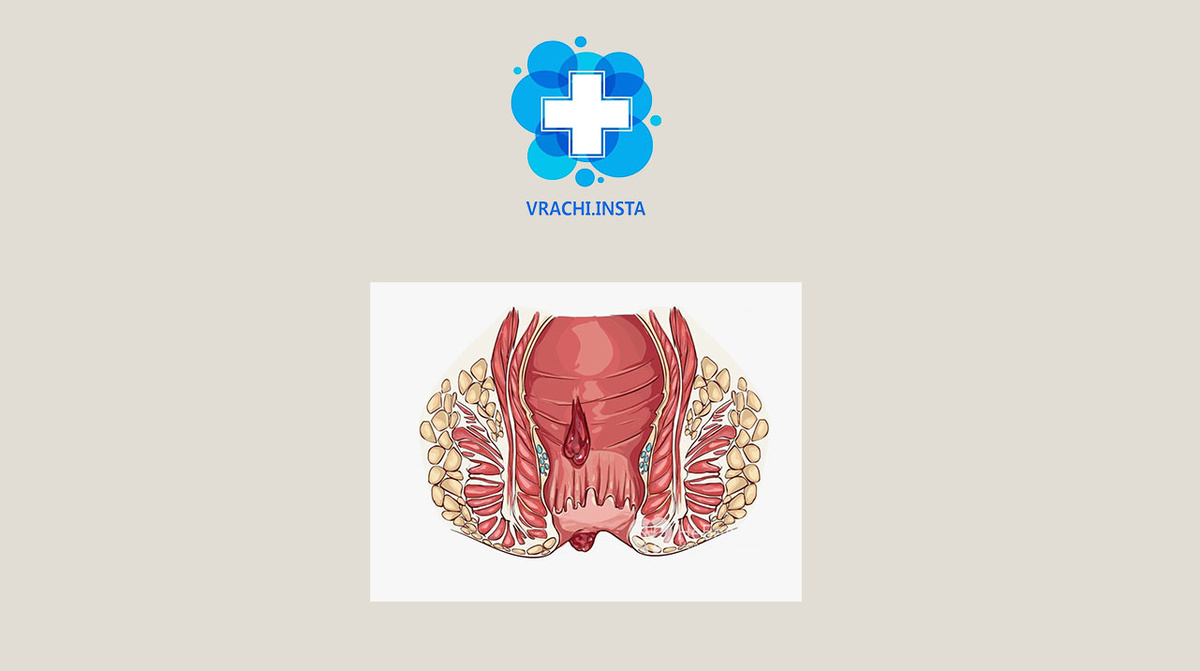 На приём обратилась пациентка, которая годами мучилась от постоянных рецидивов геморроидальной болезни и анальной трещины.

К обеим этим проблемам привёл её длительно существующий ЗАПОР.
