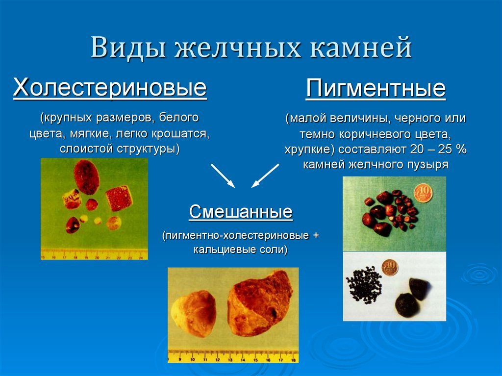 Камни желчного пузыря фото состав Камни в желчном пузыре - холестериновые, билирубиновые и кальциевые: можно ли их