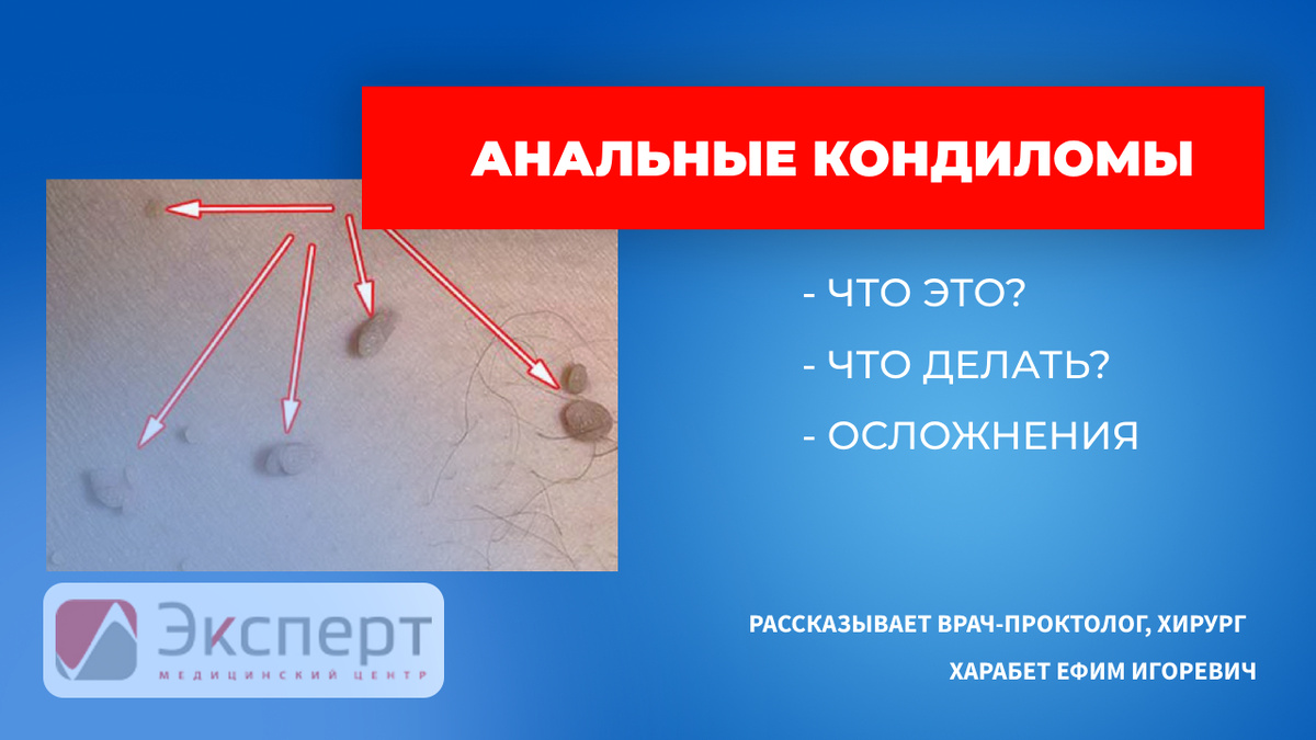 Анальные кондиломы