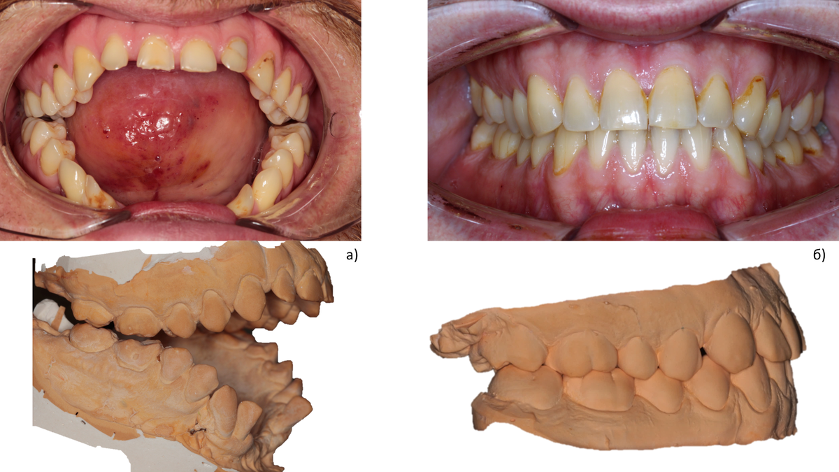 Прикус а) экстремально патологический б) в норме