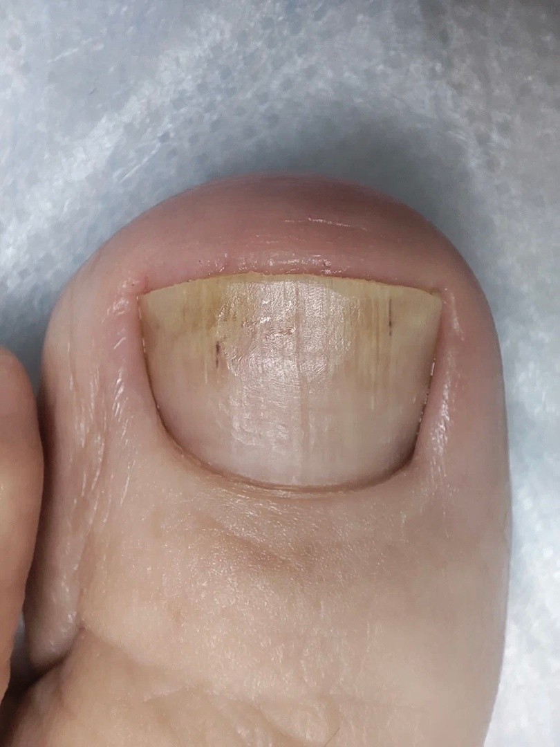 В данной статье разберем довольно часто встречающееся явление в кабинете педикюра — онихокриптоз, а если проще — вросший ноготь. Это патология, от которой страдают многие люди.-3