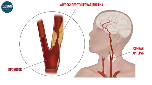 Стеноз сонной артерии: симптомы стеноза. Атеросклеротический стеноз сонных артерий