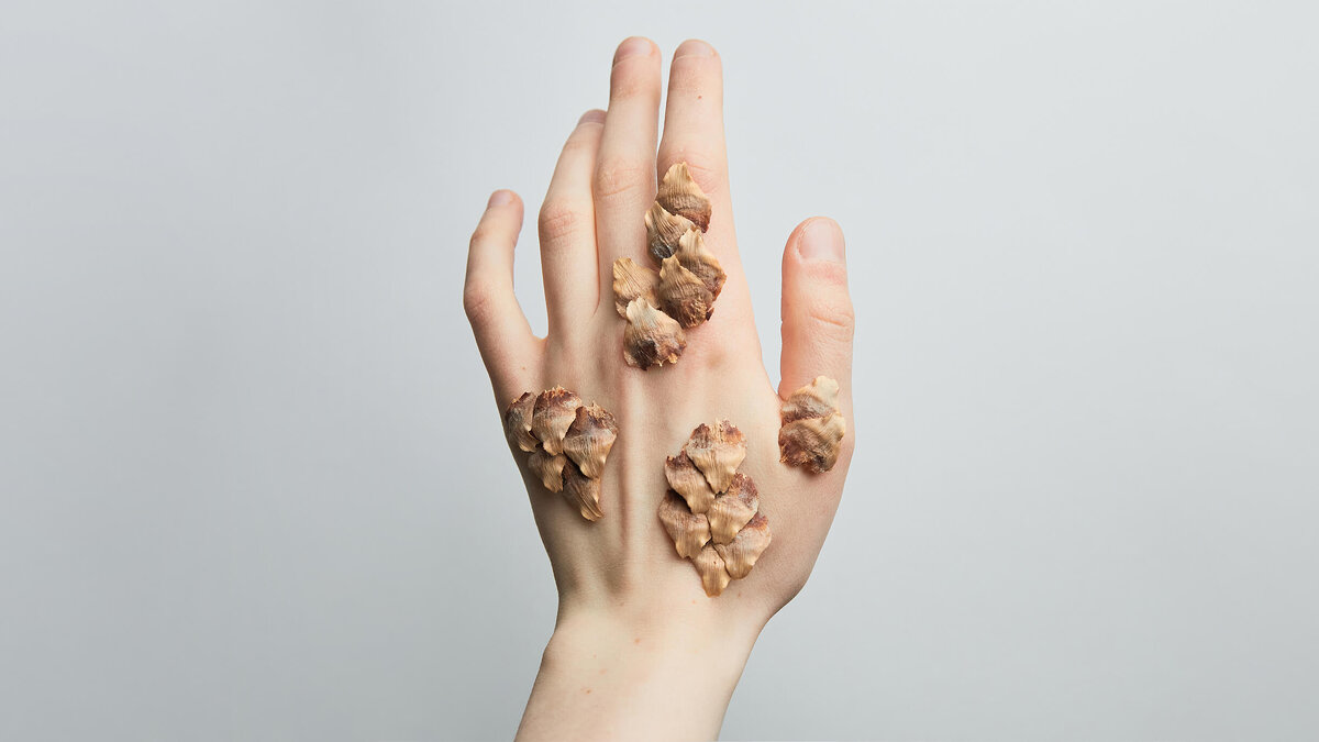    Псориаз — серьезное заболевание, которое доставляет людям физические и моральные страдания. Источник фото: journal.tinkoff.ru