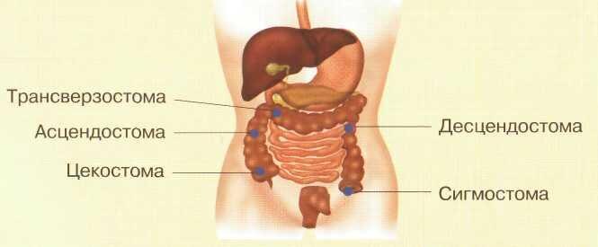 Типы колостом по месту расположения