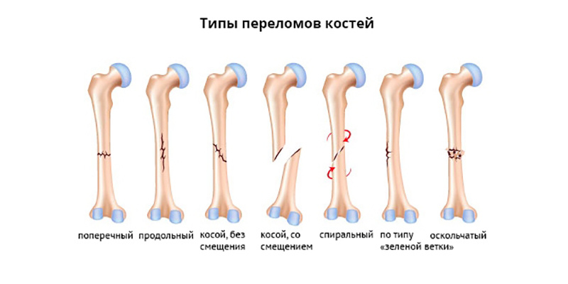 Типы переломов. Что делать при переломе кости?