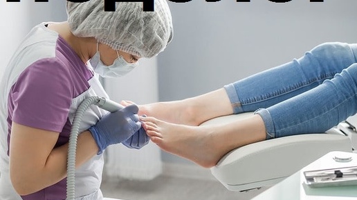 Процедура обрезки пожелтевших вросших ногтей на ногах. #подолог #подологиявросшийноготь #онихогрифоз