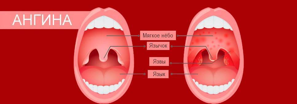 Летняя ангина у ребенка - в чем причины воспаления и несколько опасна болезнь О 