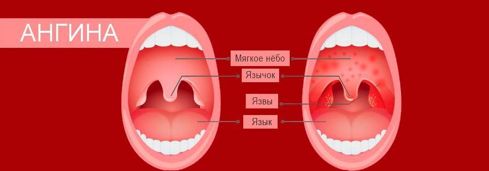 Ангина на небе фото Летняя ангина у ребенка - в чем причины воспаления и несколько опасна болезнь О 