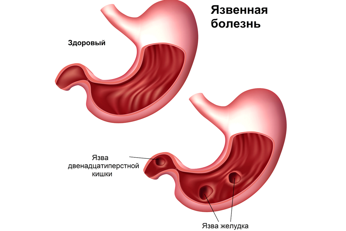 Язва желудка не всегда болит – если вы входите в эти группы риска,  проверьтесь! | О здоровье: с медицинского на русский | Дзен