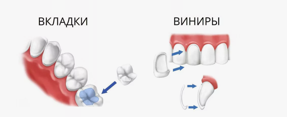 Вкладками восстанавливают зубы, разрушенные более чем на треть, но менее чем наполовину. Винирами устраняют эстетические дефекты на лицевой поверхности зубов