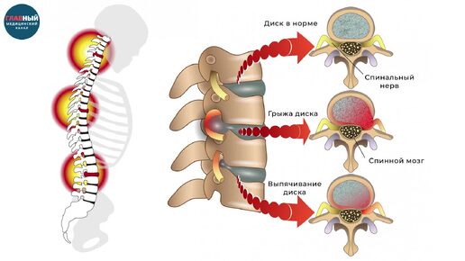 Грыжа позвоночника: симптомы межпозвоночной грыжи. Что поможет от грыжи