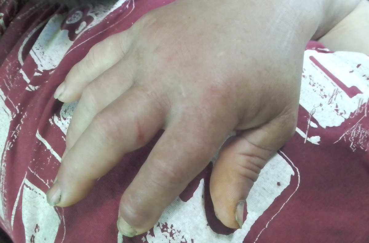 Укус гадюки обыкновенной - день первый