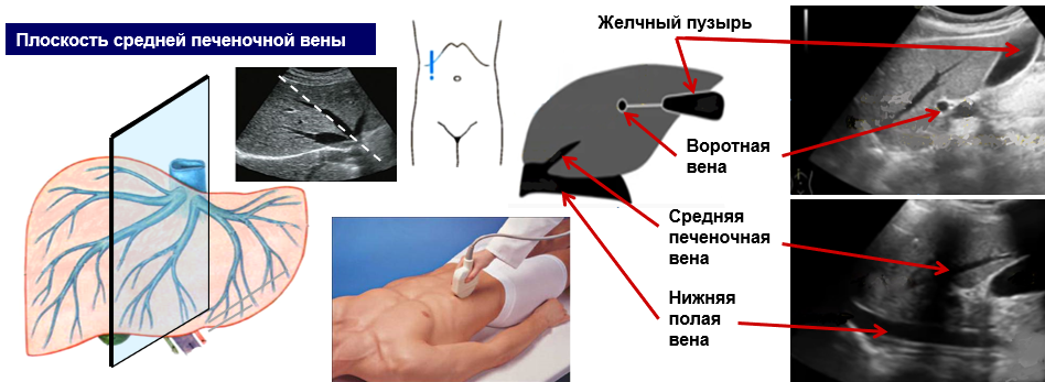 УЗИ желчевыводящей системы обычно проводится в рамках УЗИ печени (органов брюшной полости). Положение пациента – на спине, при необходимости – на боку.-2