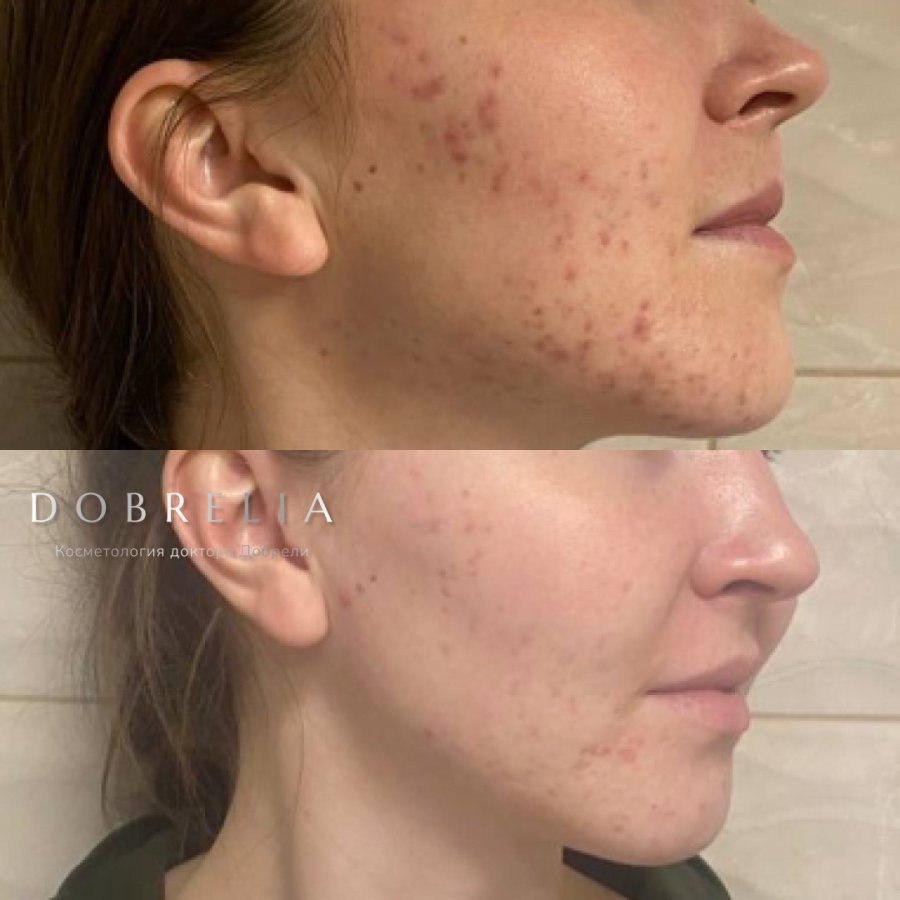 Удаления новообразований коагулятором в Томске