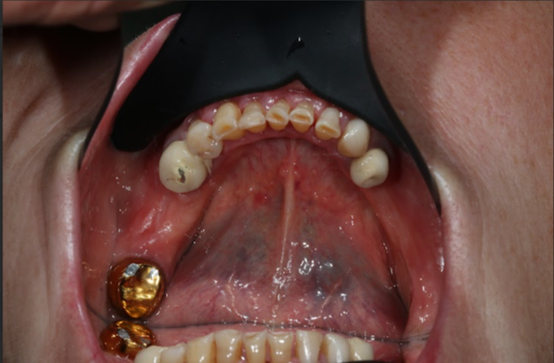 Нижняя челюсть ДО