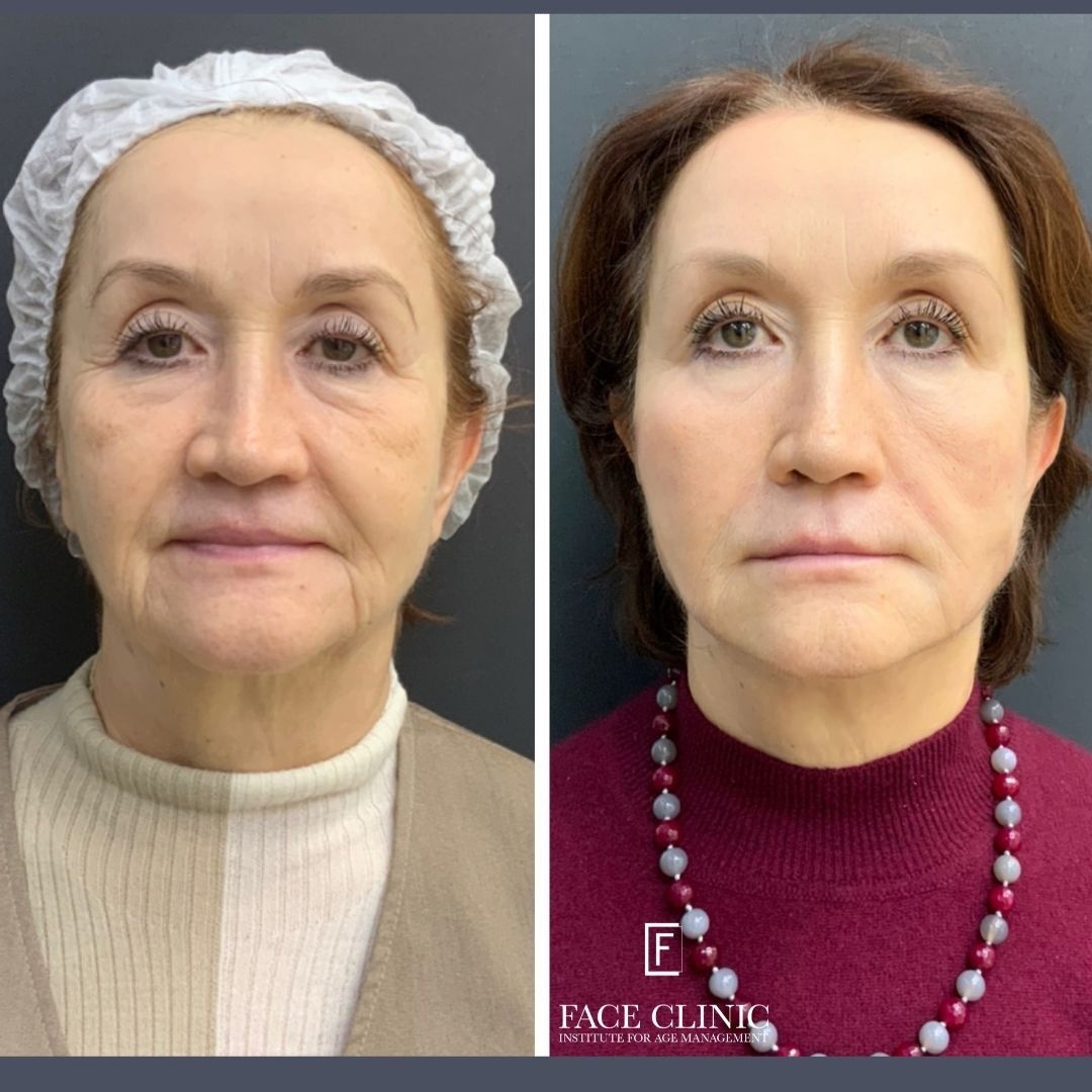 Возможно ли начать заниматься косметологией после 65 лет? | Face Clinic |  Клиника косметологии в Москве | Дзен