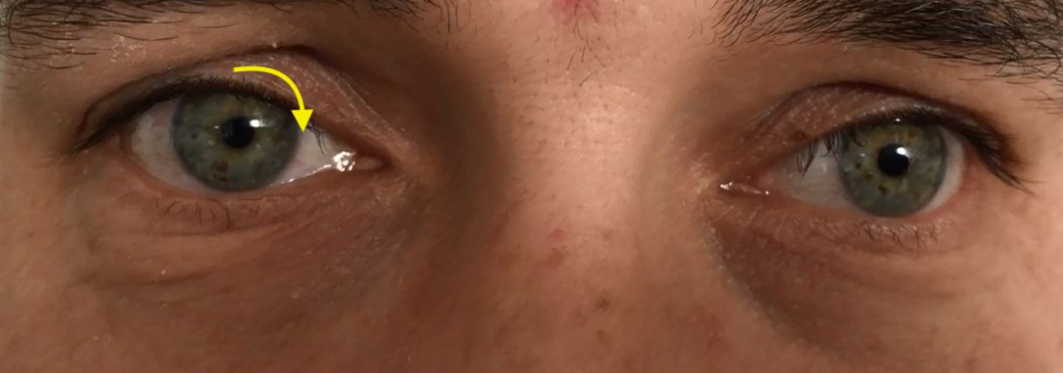 Веко дергается вниз-вверх с небольшой амплитудой при открытых и закрытых глазах