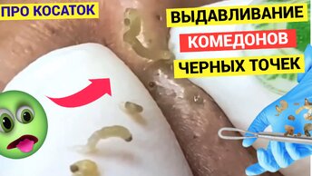 Выдавливать Комедоны Еще позже Бы Пришел. Зарос Черными Точками своими. История про косаток