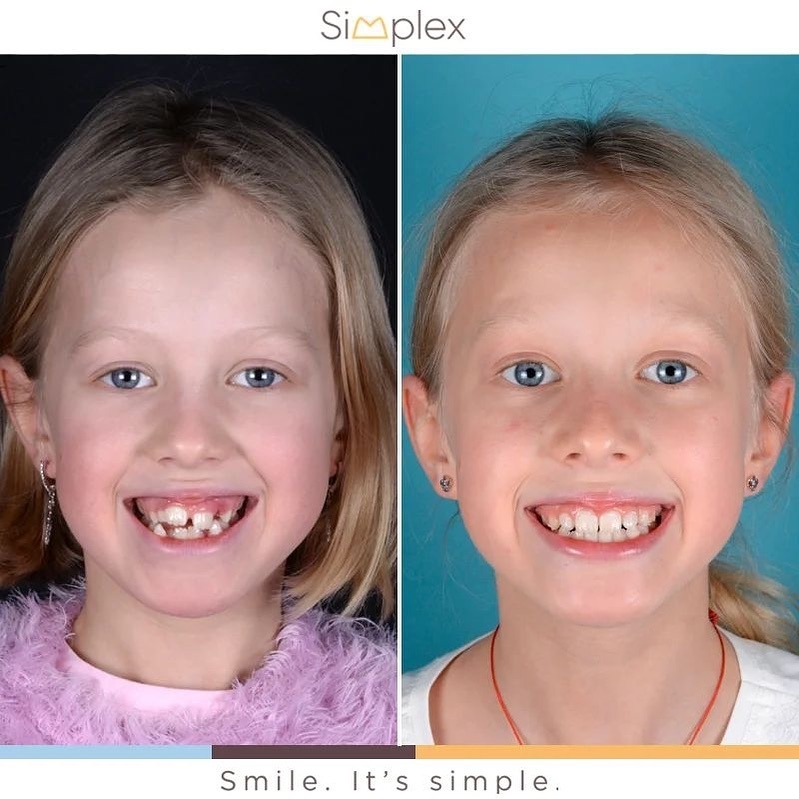 Результат лечения на элайнерах, срок - 12 месяцев. Врач-ортодонт Бажанова О.В..