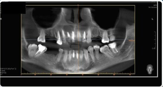 Изначальная ситуация. Виден огромный очаг в области 11,12,13 зубов.