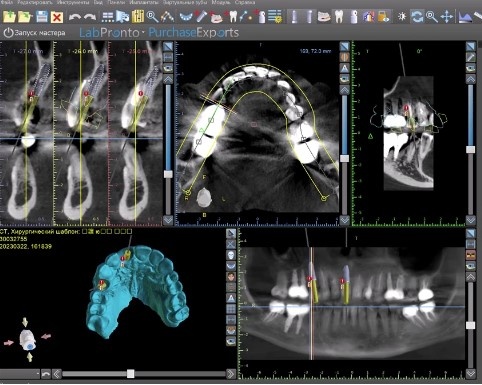 Сопоставление в специальной программе данных компьютерной томографии и цифрового скана зубов.