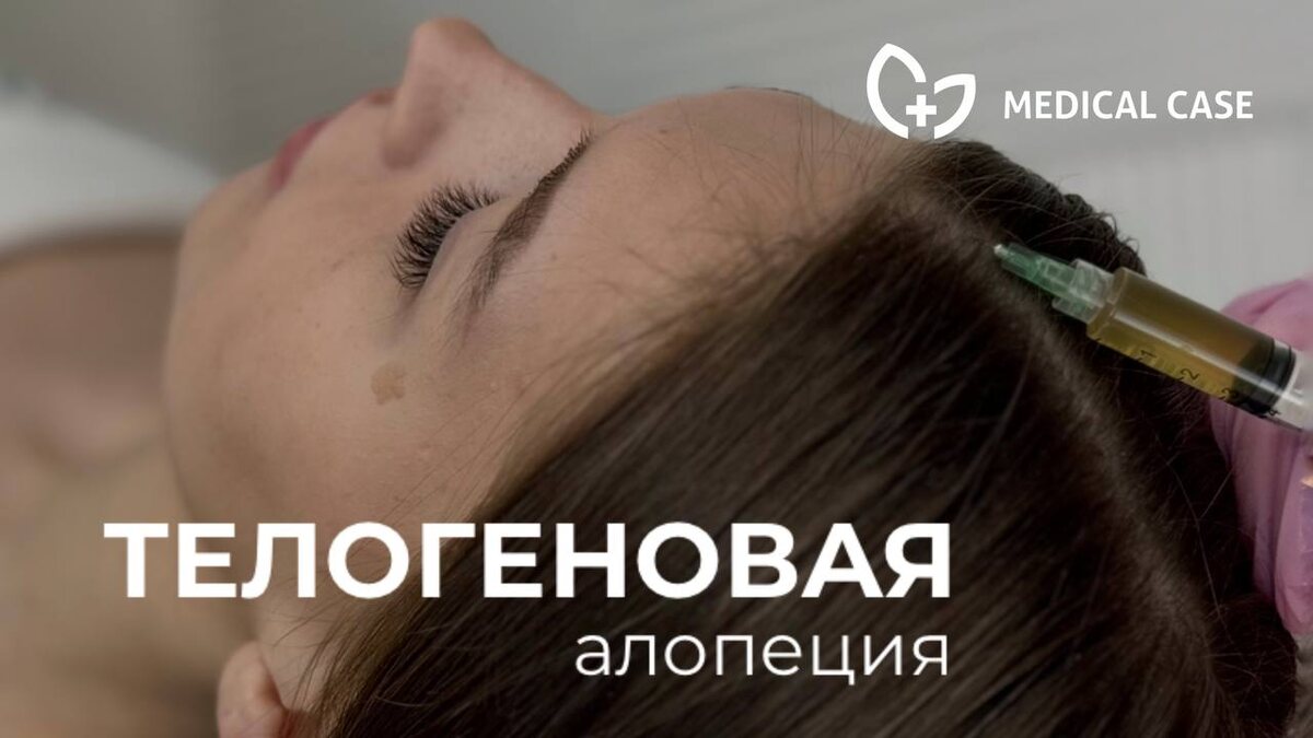 Телогеновая алопеция | Medical Case | Дзен