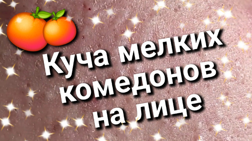 Пупырки на лице? Не беда! БЕГИ к косметологу, он всё ИСПРАВИТ! 